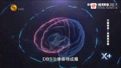 Brain-circuit illustration related to DBS