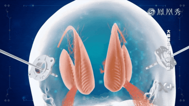 Programme illustration of implanted electrodes