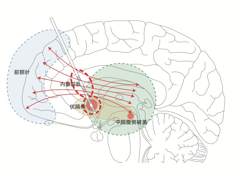 Professional DBS clinical reference illustration