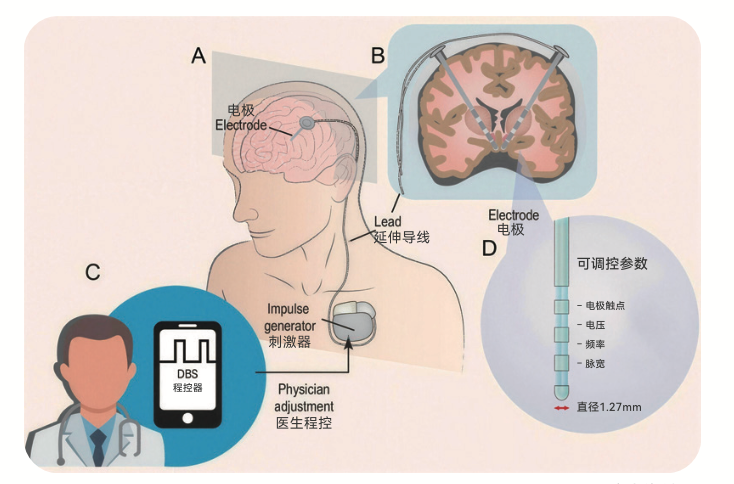 Professional DBS clinical reference illustration